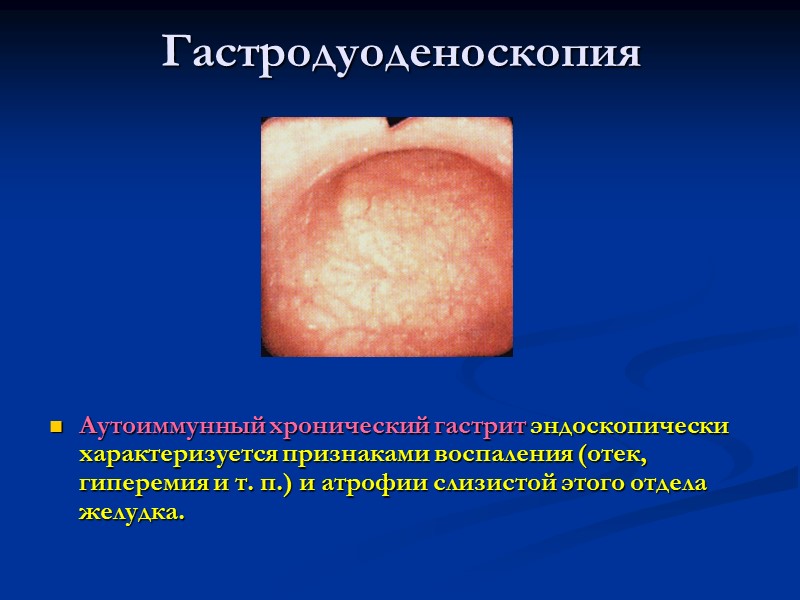 Гастродуоденоскопия Аутоиммунный хронический гастрит эндоскопически характеризуется признаками воспаления (отек, гиперемия и т. п.) и